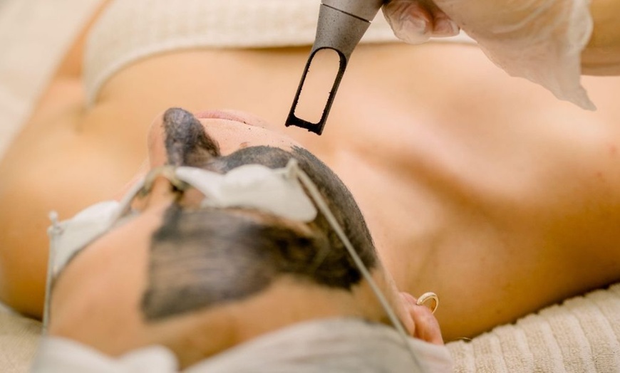 Image 4: Carbon Laser Peel with Deep Pore Cleansing and Instant Glow
