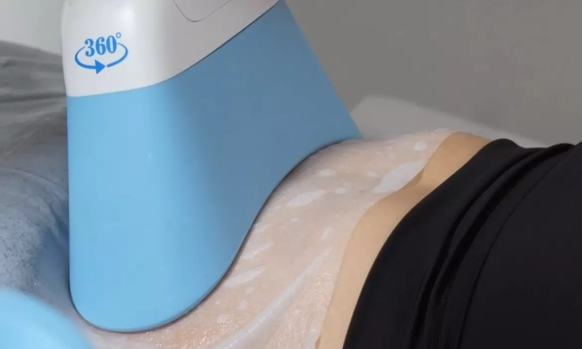 1, 2 oder 3 Kryolipolyse-Behandlungen an einer Zone für 1 Person