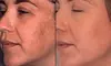 Revitalize w/ Moxi Laser Skin, Face & Neck Resurfacing Up to 50% Off at Eyesthetics