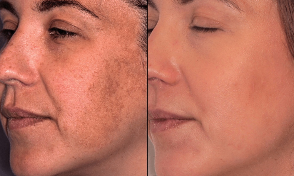 Transform with Moxi Laser Skin, Face & Neck Resurfacing