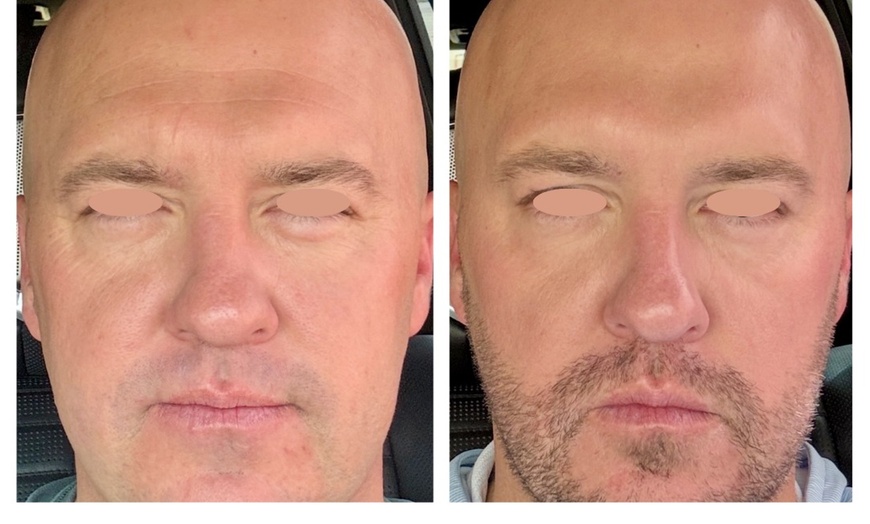 Image 5: One or Three Sessions of TetraPRO or CoolPeel CO2 Fractional Laser on Choice of Treatment Areas (Up to 50% Off)