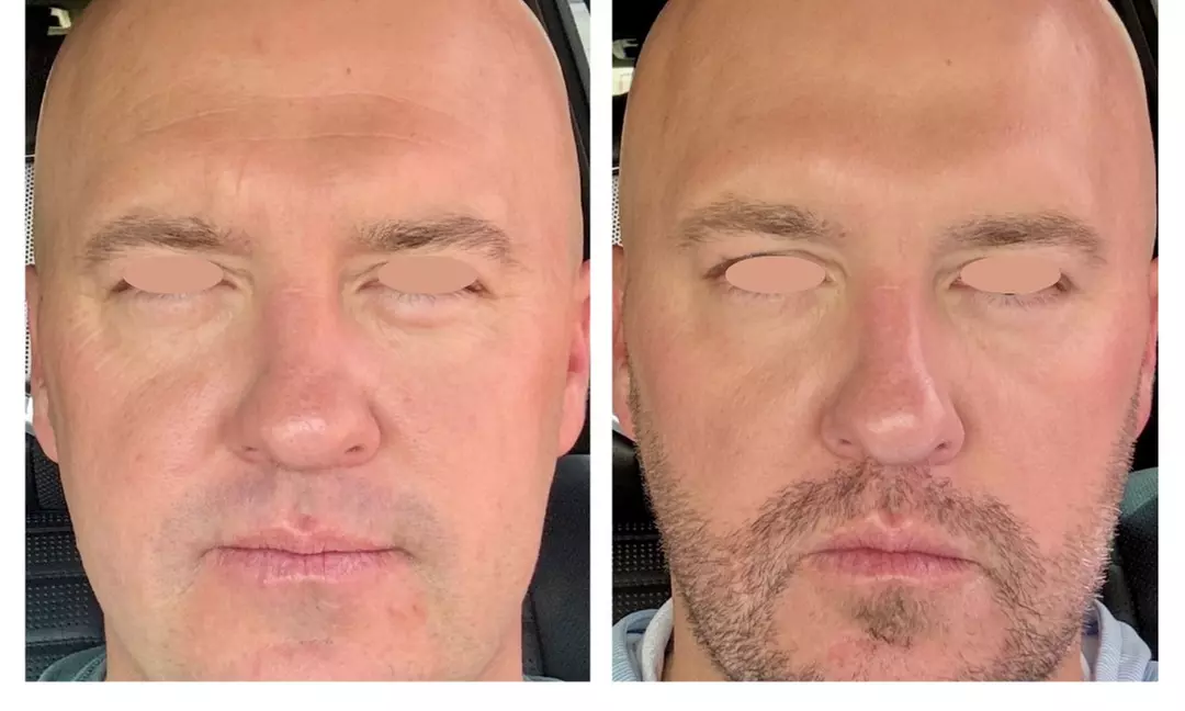 One or Three Sessions of TetraPRO or CoolPeel CO2 Fractional Laser