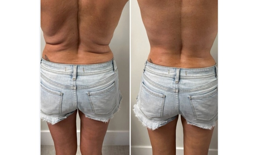 Image 3: Get One Session on Small Area: Mesotherapy Fat Melting (PCDC)