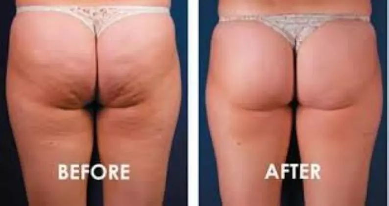 Reshape & Smooth with ShockWave Cellulite Therapy — 3, 6, or 12 Packs