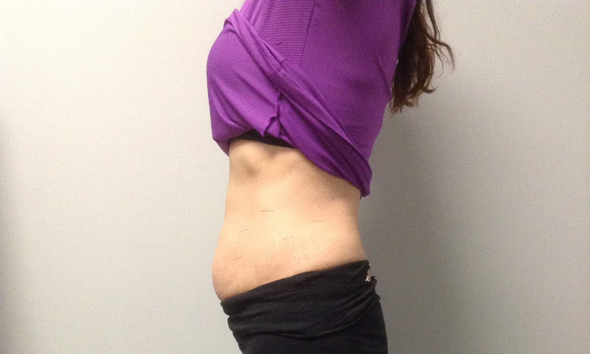 Experience iLipo Treatments for Effective Body Contouring