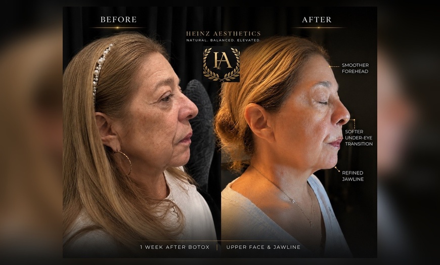 Image 11: Renew Your Skin w/ 20, 40, Units of Botox & Optional Filler Treatments