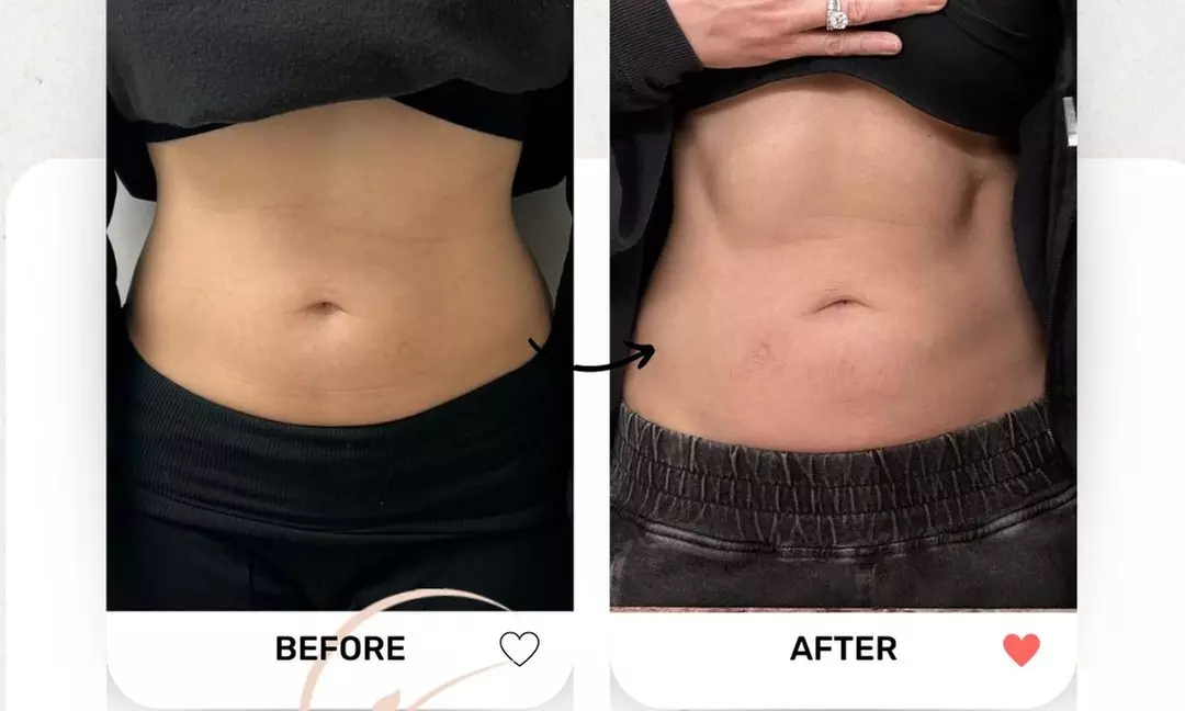 Up to 50% Off on Electrical Muscle Stimulation at Nutri-Sculpt LLC