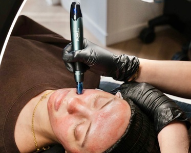 One Micro-needling Treatment with LED Light Therapy - Essence Esthetics