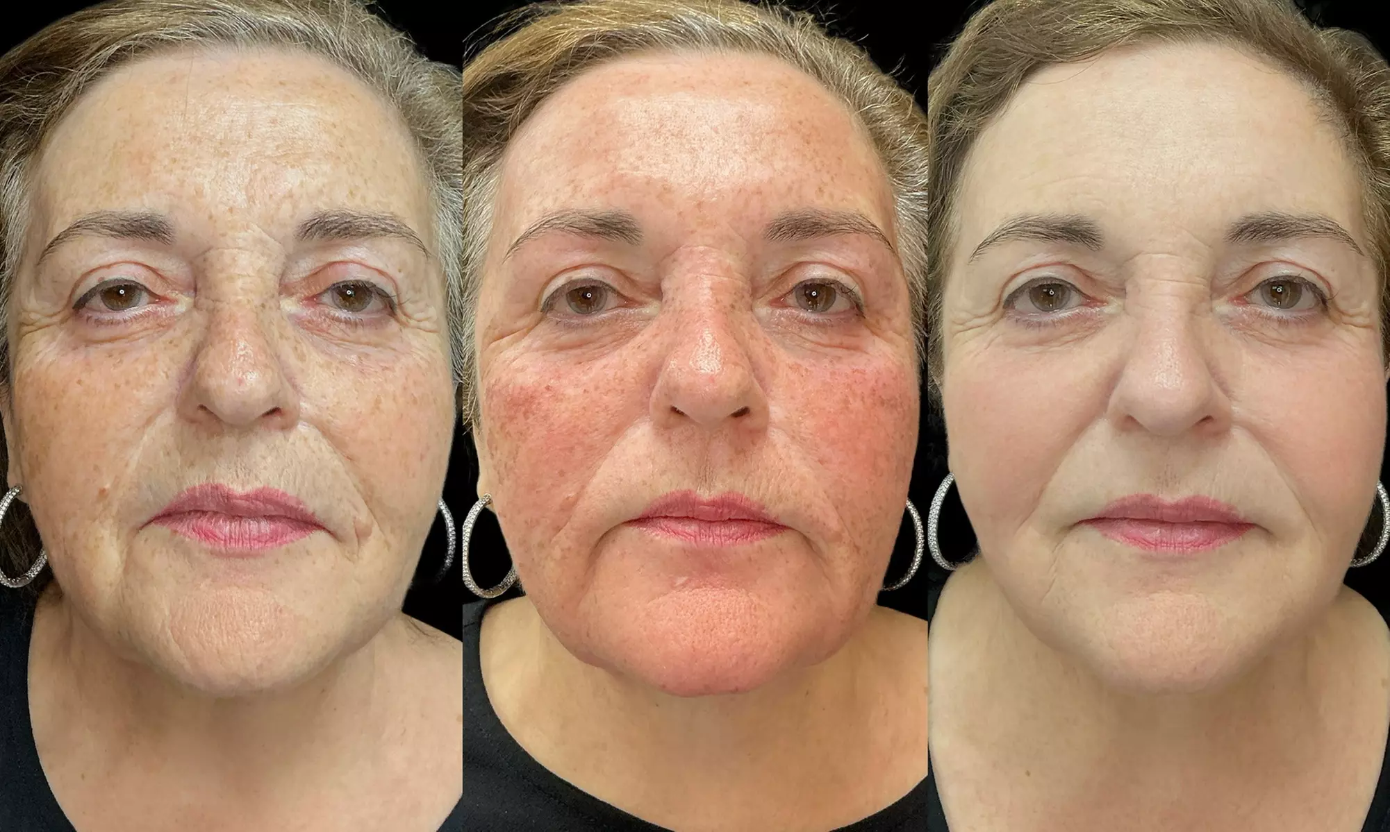 One Fraxel Laser Skin Resurfacing Treatment for Neck or Full Face at Diamond Advanced Aesthetics (Up to 45% Off) - Second Medium