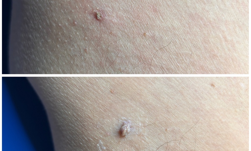 Image 6: Up to Unlimited Skin Tags, Milia, Blood Spot or Mole Wart Removal