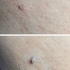 Image 6: Up to Unlimited Skin Tags, Milia, Blood Spot or Mole Wart Removal