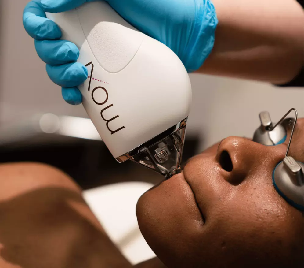 Comprehensive MOXI Laser Resurfacing – Face, Neck and Décolletage