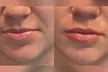 Up to 44% Off on Injection - Organic Filler at PMU + MD AESTHETICS - Second Medium