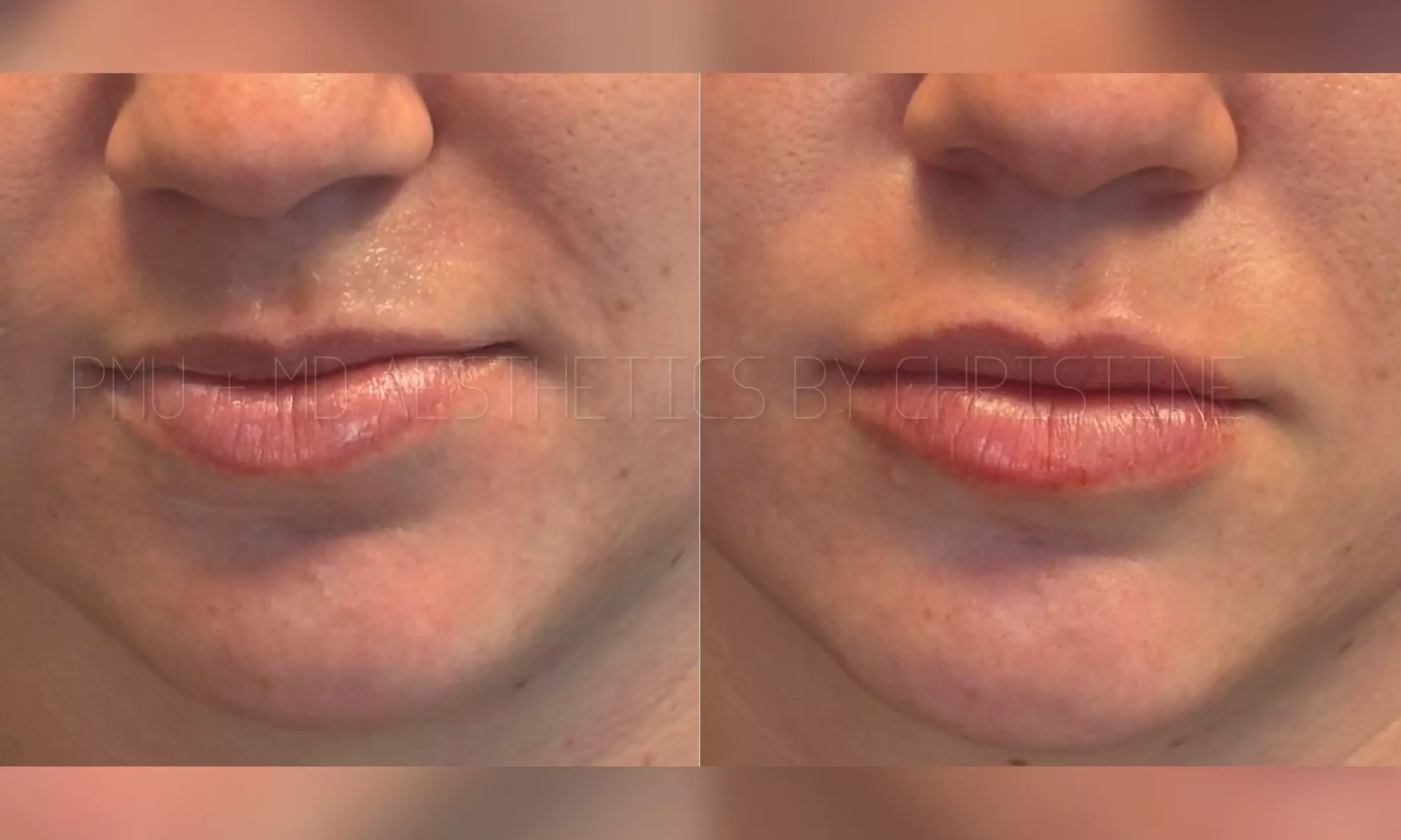 Up to 45% Off on Injection - Juvederm Filler 