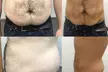 Non-Surgical Solution: Fix Stubborn Fat with Lipo Sculpt Lite - Second Medium