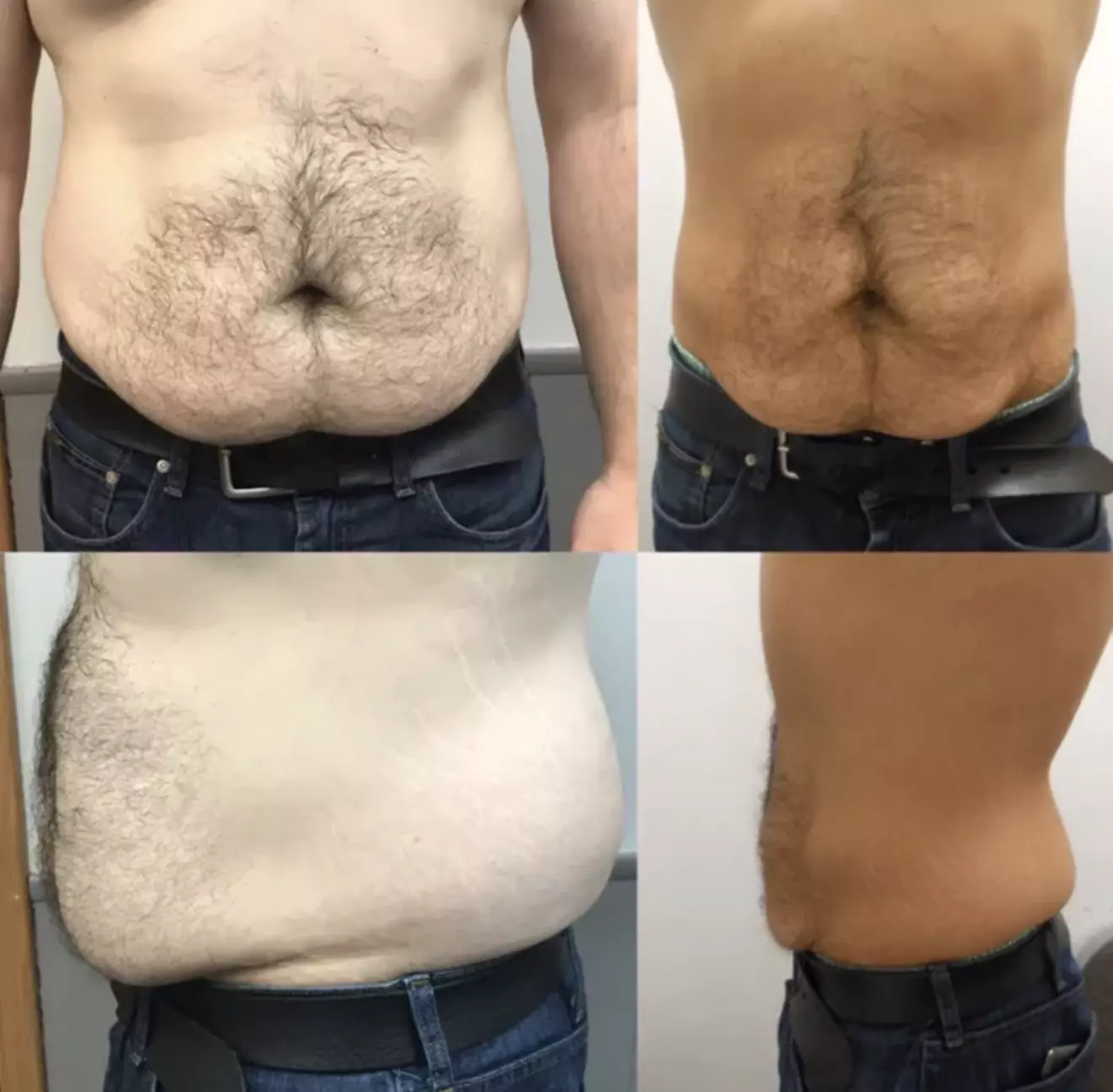 Non-Surgical Solution: Fix Stubborn Fat with Lipo Sculpt Lite