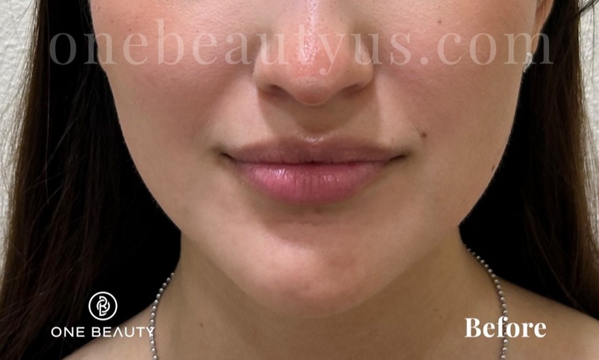 Image 2: Up to 52% Off on Injection - Dermal Filler at One Beauty Aesthetics