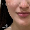 Image 2: Up to 52% Off on Injection - Dermal Filler at One Beauty Aesthetics