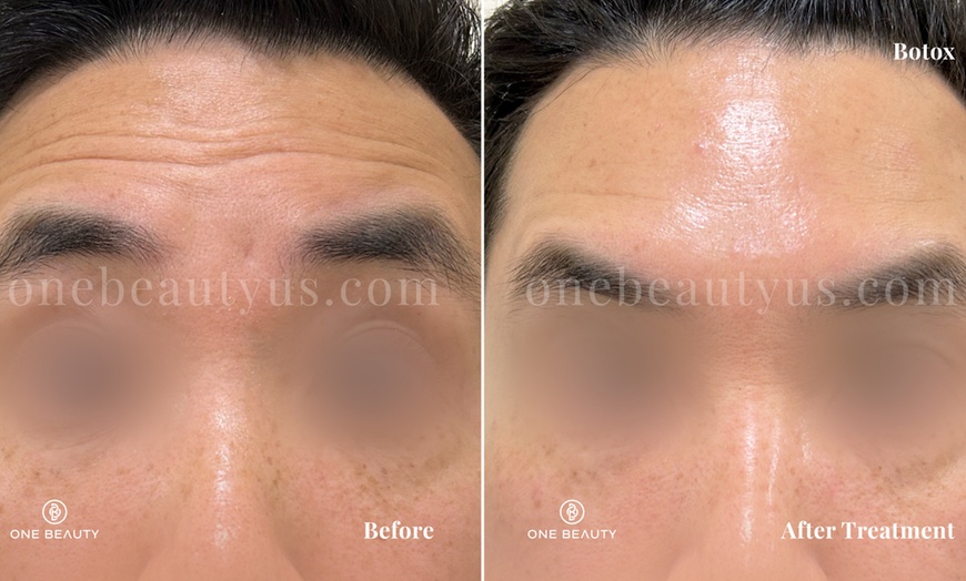 Image 2: Up to 51% Off on Injection - Botox at One Beauty Aesthetics
