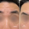 Image 2: Up to 51% Off on Injection - Botox at One Beauty Aesthetics