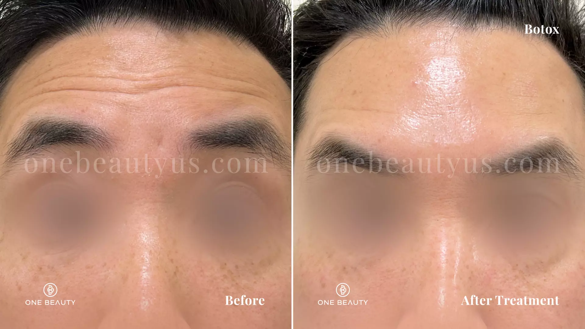 Up to 54% Off on Injection - Botox at One Beauty Aesthetics