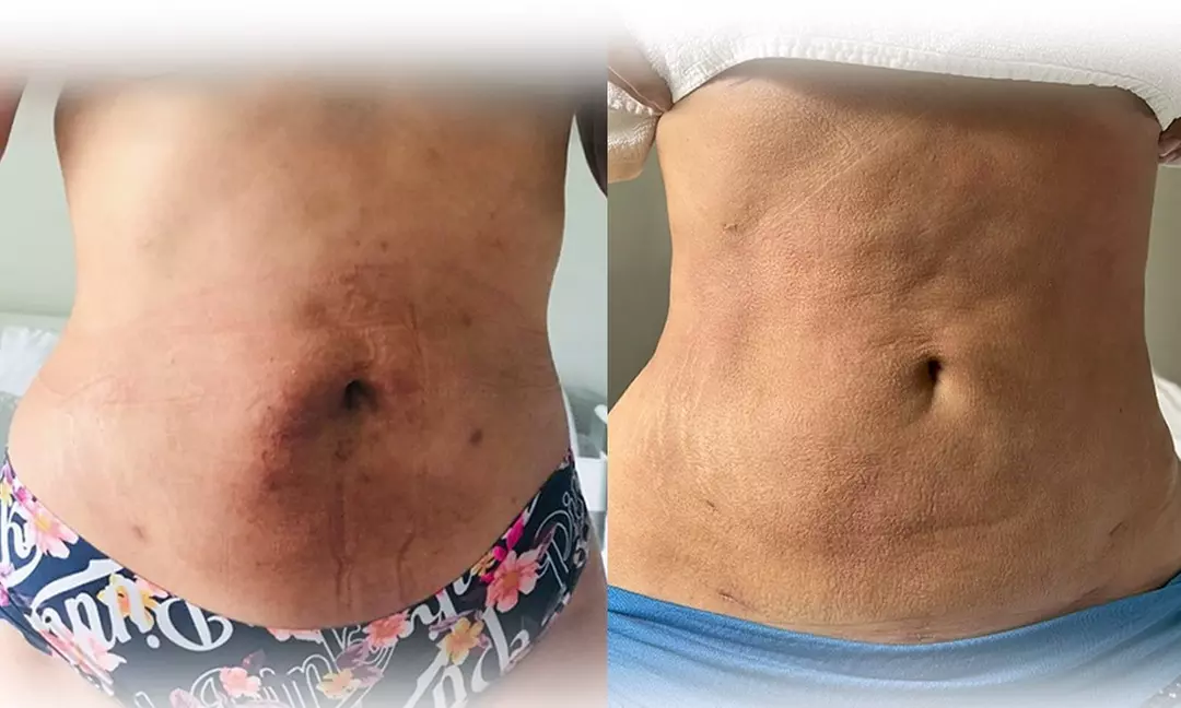 One 60-Min Lymphatic Drainage, Post-op, or Body Sculpting Massage at Hope 360 Post (Up to 55% Off) - Image 3