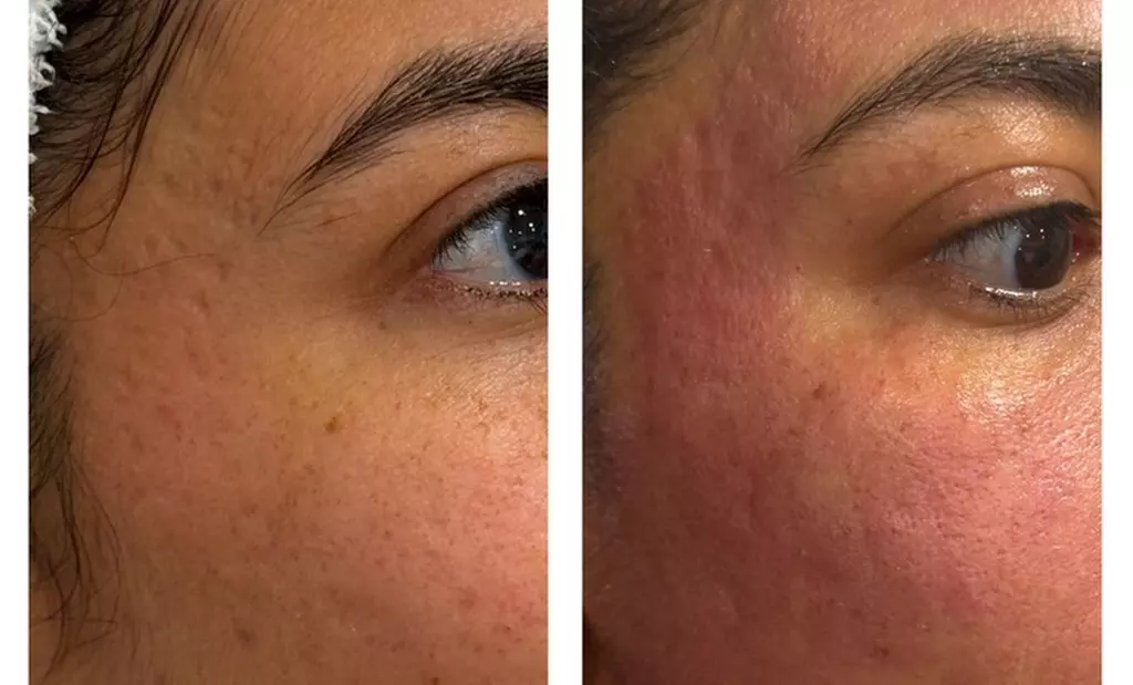 Revitalize Your Skin with 30 or 60-Minute Chemical Peels