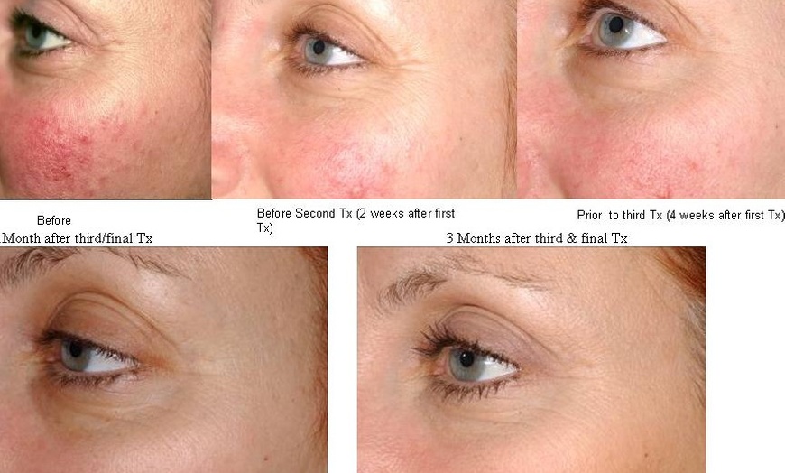 Image 2: Transform Your Skin with Laser Genesis Session at Vascular Cosmetics