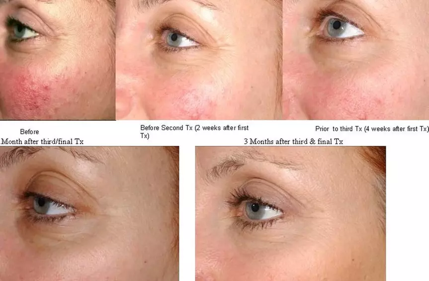 Transform Your Skin with Laser Genesis Session at Vascular Cosmetics