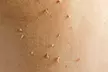 Up to 50% Off on Plasma Pen Treatment at Gentlelase Laser Aesthetics - Second Medium