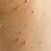 Image 2: Up to 50% Off on Plasma Pen Treatment at Gentlelase Laser Aesthetics