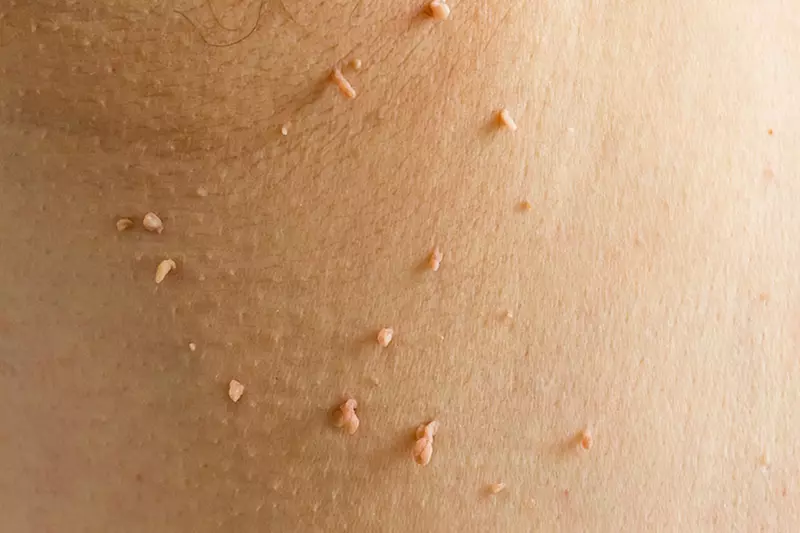 Plasma Pen for Skin Tags, Spots & Milia: Choose 5, 10, or 10+ Removals