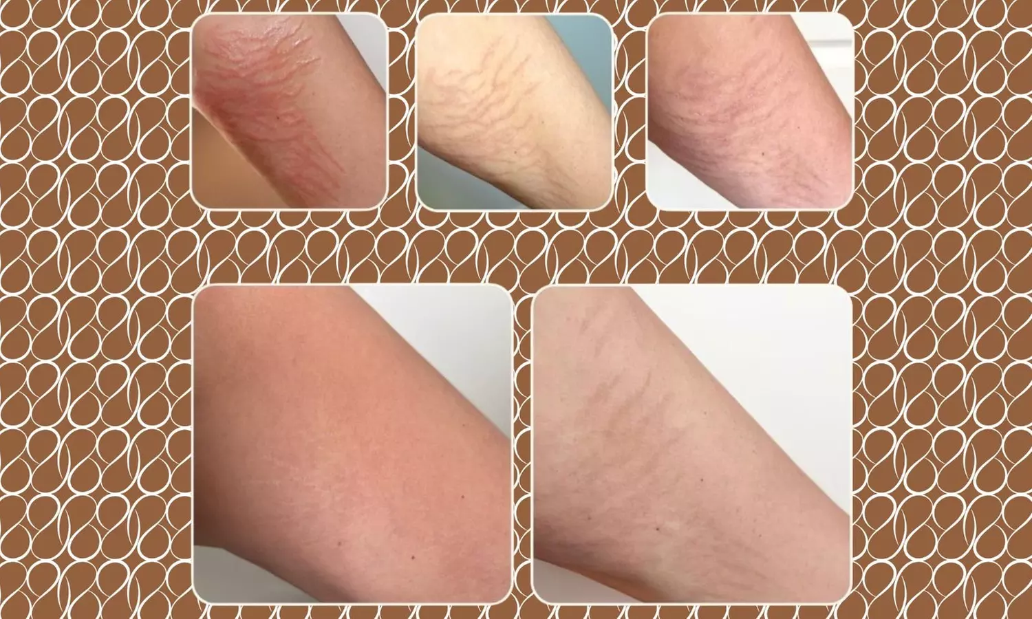 Three DermaLiss Stretch Mark Treatment Sessions – Small to XL Areas