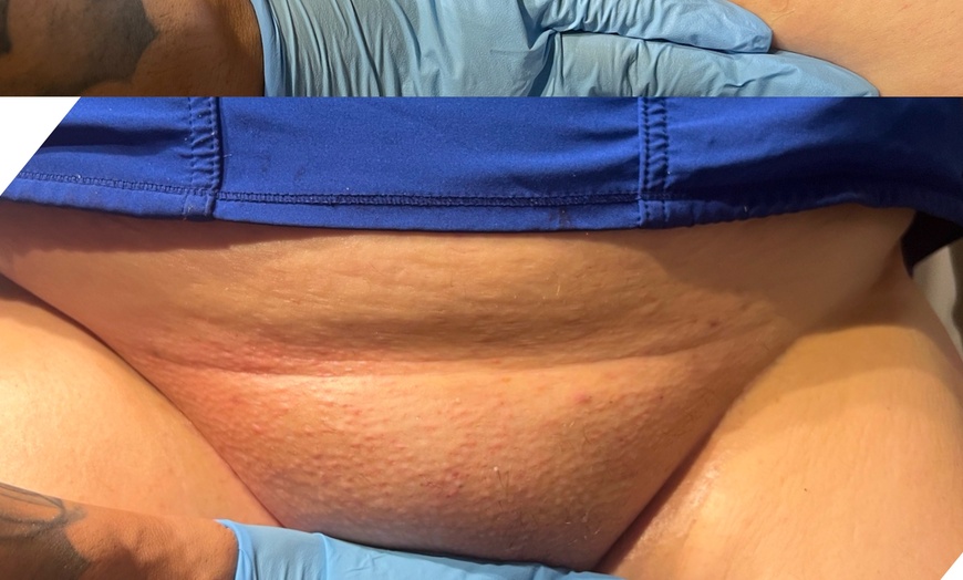 Image 2: Waxing Packages: One or Ten Brazilian/Bikini Wax Treatments