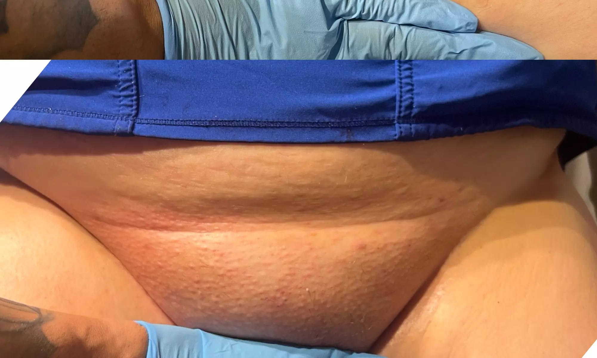 Waxing Packages: One or Ten Brazilian/Bikini Wax Treatments (Up to 30% Off) at Kaykayzwave - Second Medium