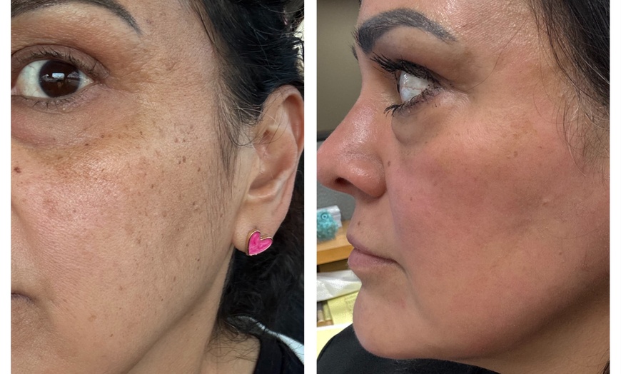 Image 7: Transform Your Skin with One or Three CO2 Skin-Resurfacing Sessions