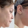 Image 1: Up to 60% Off on Facelift - Non-Surgical at NY Esthetics Clinic