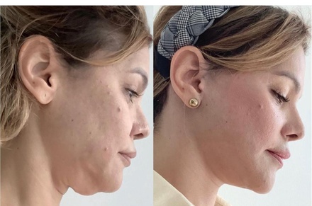 One HIFU Skin-Tightening Treatment for full face - NY Esthetics Clinic
