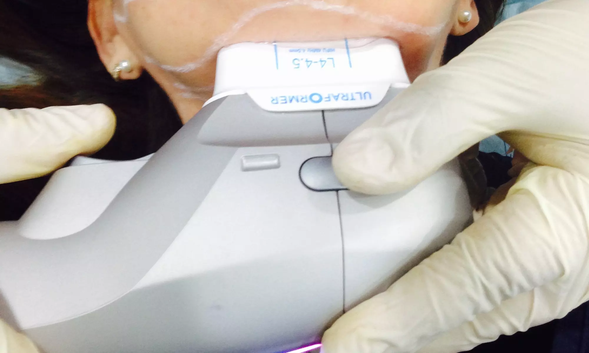 HIFU Face, Neck, or Chin Lift for a Sculpted, Youthful Look 