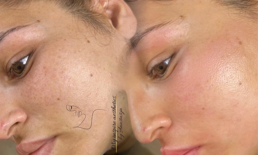 Image 1: Microneedling oder BB Glow inkl. Abreinigung für 1 Person