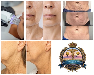 One Session of RF Skin Tightening for Full Face or Neck - Royal Medical Health Rio Rancho