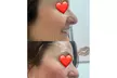 One, Two, or Four ThermaLift Skin-Tightening Facelifts at InstaSculpting (Up to 88% Off) - Second Medium
