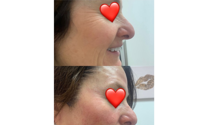 Image 2: One, Two, or Four ThermaLift Skin-Tightening Facelifts at InstaSculpting (Up to 88% Off)