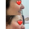 Image 2: One, Two, or Four ThermaLift Skin-Tightening Facelifts at InstaSculpting (Up to 88% Off)