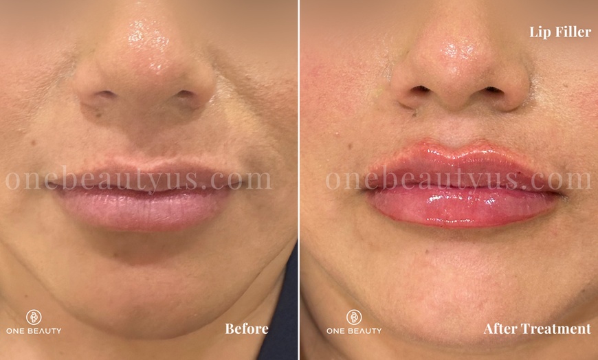Image 6: Up to 52% Off on Injection - Dermal Filler at One Beauty Aesthetics
