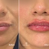 Image 6: Up to 52% Off on Injection - Dermal Filler at One Beauty Aesthetics