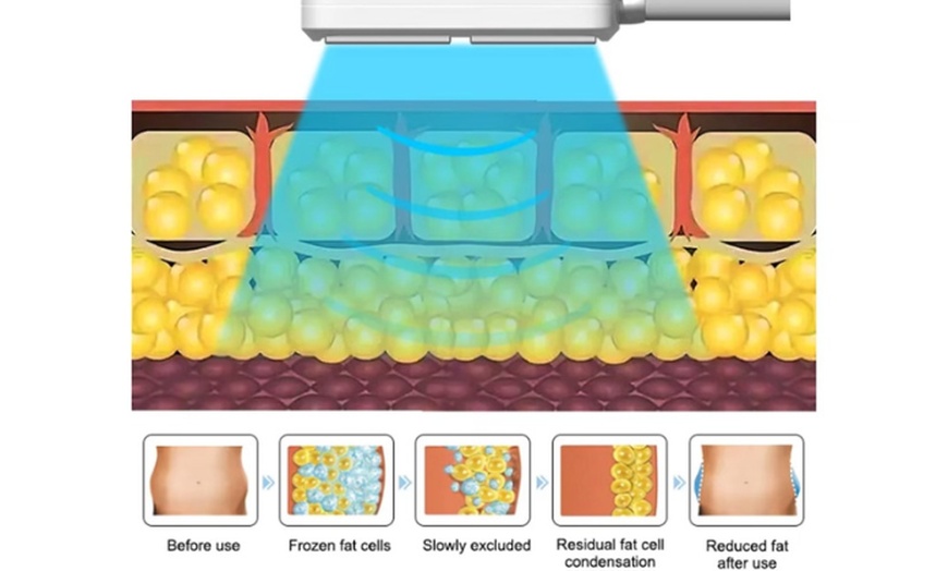 Image 4: Achieve Body Contouring With 4 or 8 Paddle Cryolipolysis