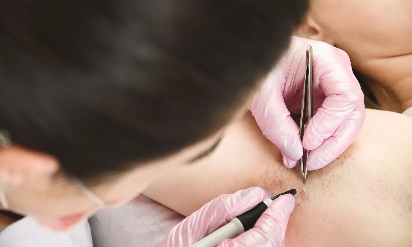 Smooth Skin Awaits with 15, 30, 45, or 60-Min Electrolysis Sessions with Consultation(Up to 60% Off) - Primary Image