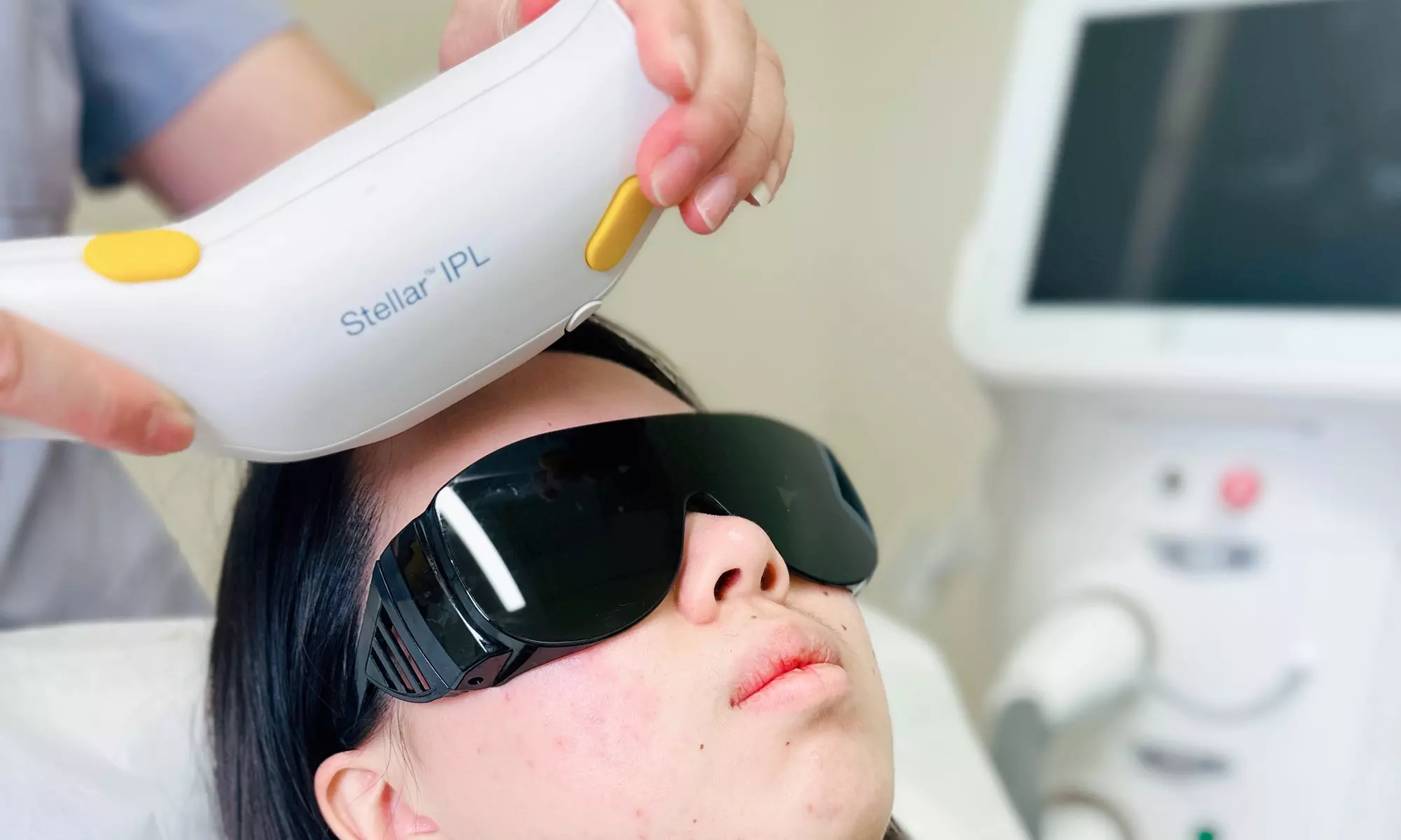 One or Two Stellar M22 IPL Photofacial Treatments for Radiant Skin