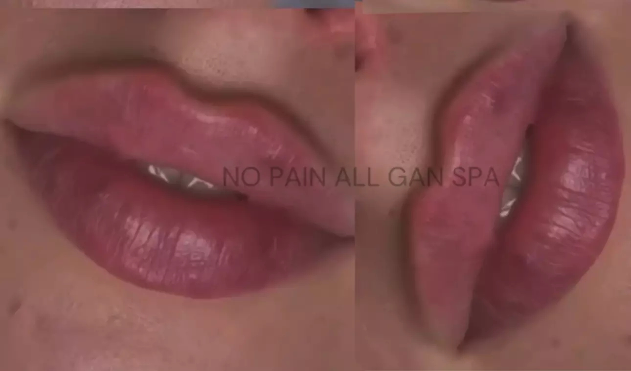 Up to 30% Off on Injection - Dermal Filler at No Pain All Gain Spa - Primary Image